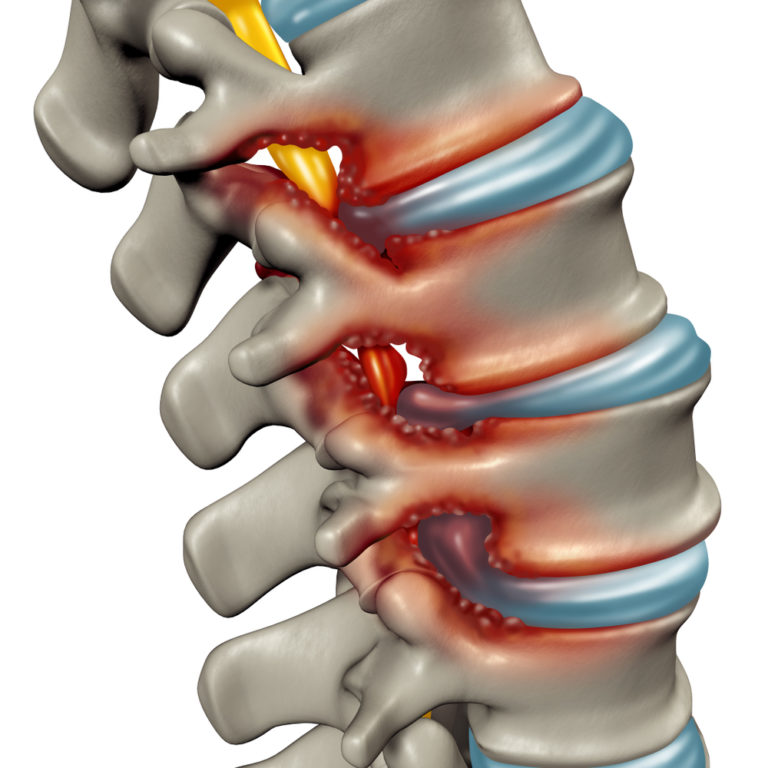 what-is-spinal-stenosis-front-range-center-for-brain-spine-surgery